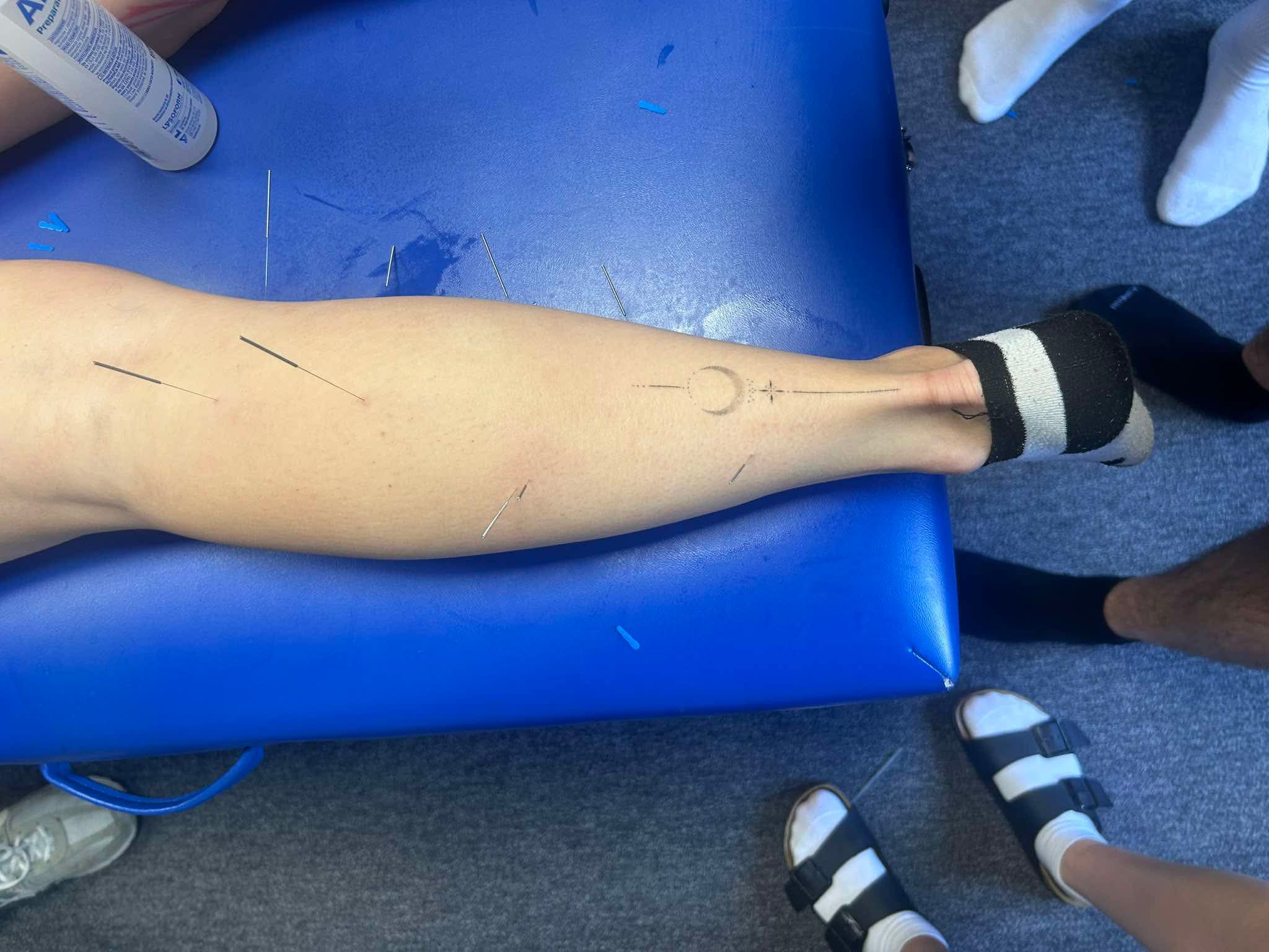 suche iglowanie - Fizjoterapia Agata Klefas suche iglowanie